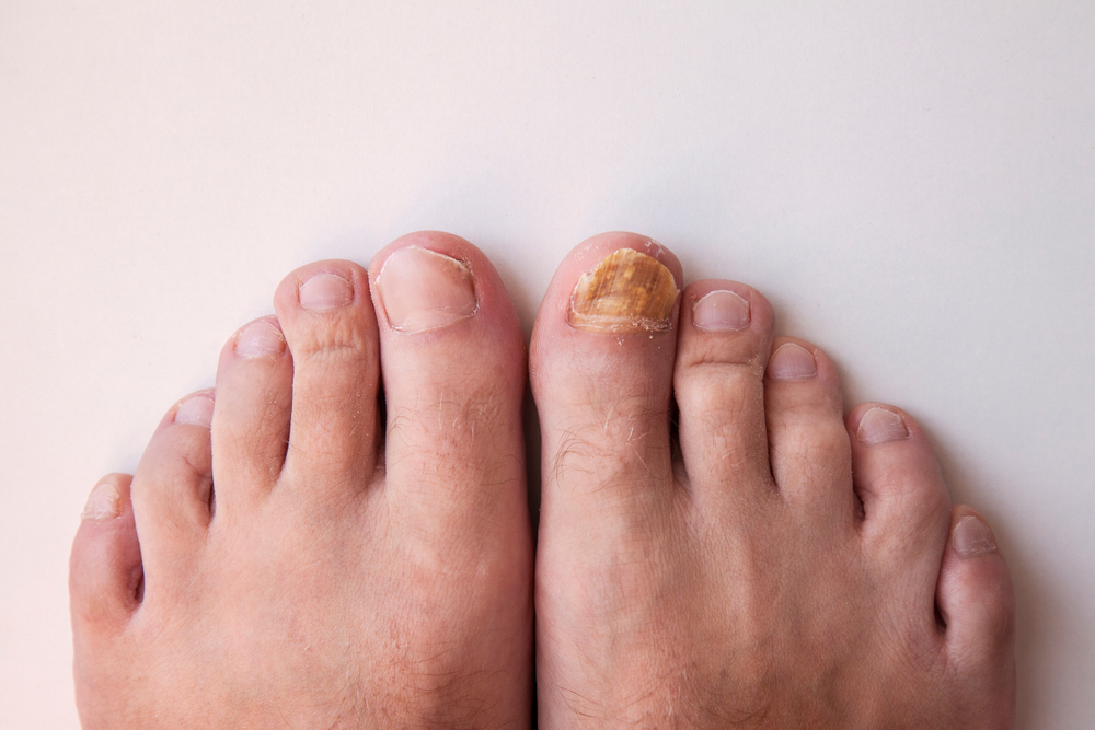 Toenail Fungus